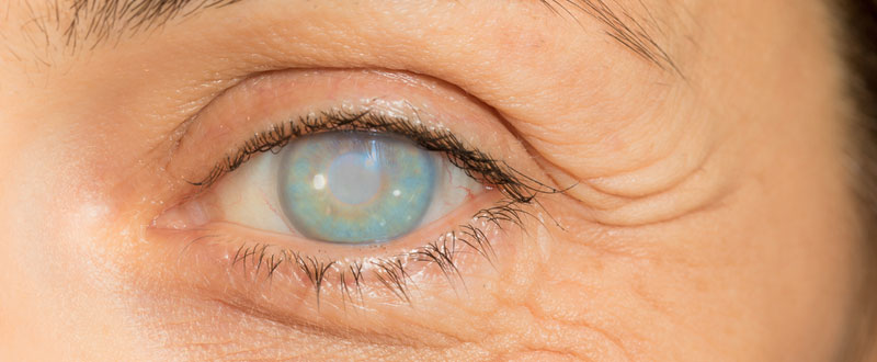 Corneal Blindness Treatment in Delhi - Causes, Prevention & Cure