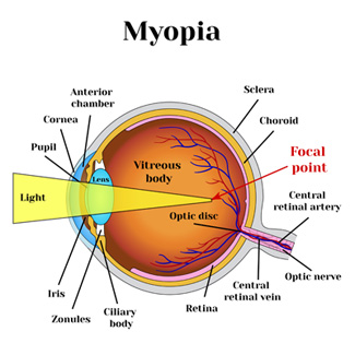 Illustration showing myopic eye