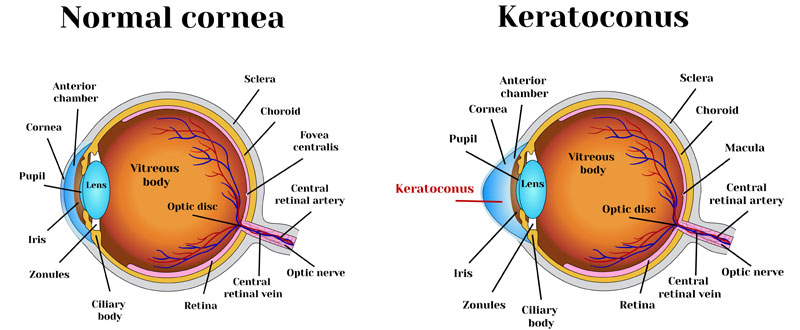 Comparison of normal cornea with Keratoconus